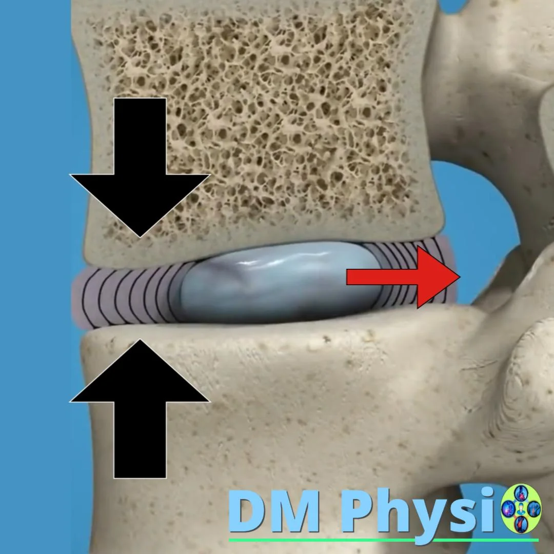 Анатомия на дискова херния на гърба